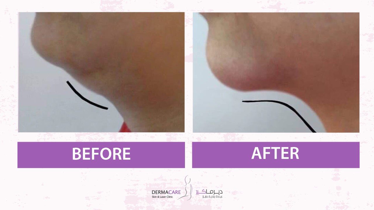 Double Chin and Neck