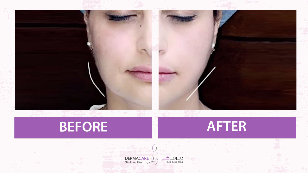 Non-surgical Face Lift