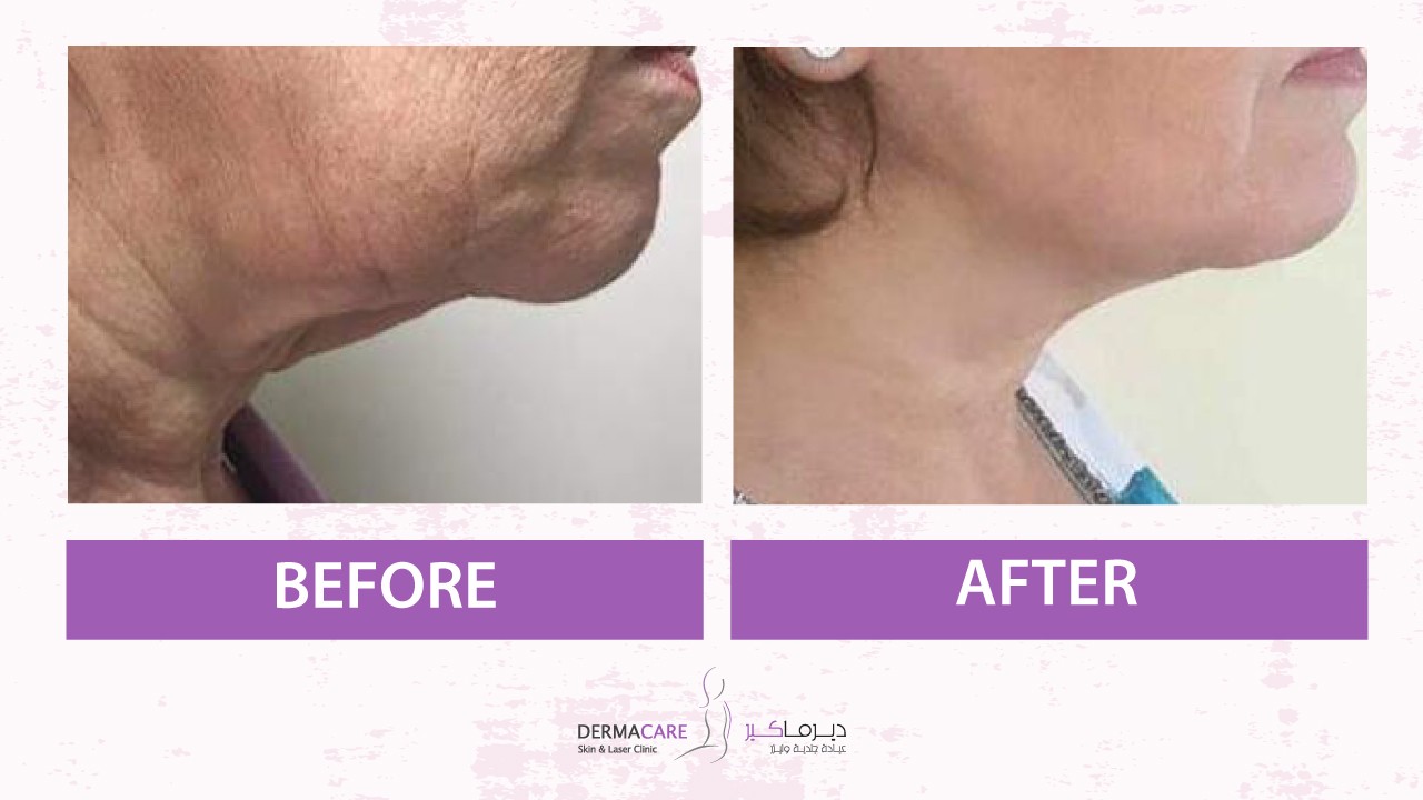 Double Chin and Neck