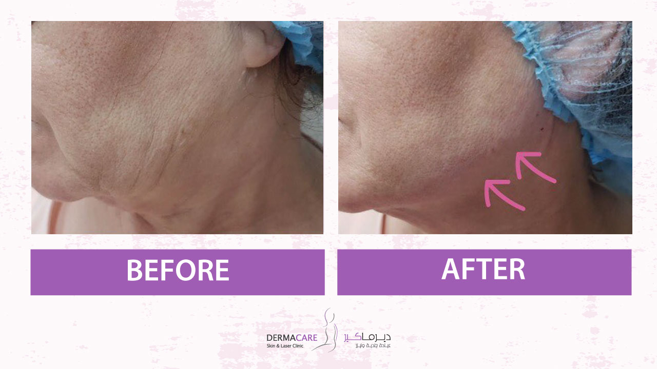 Non-surgical Face Lift