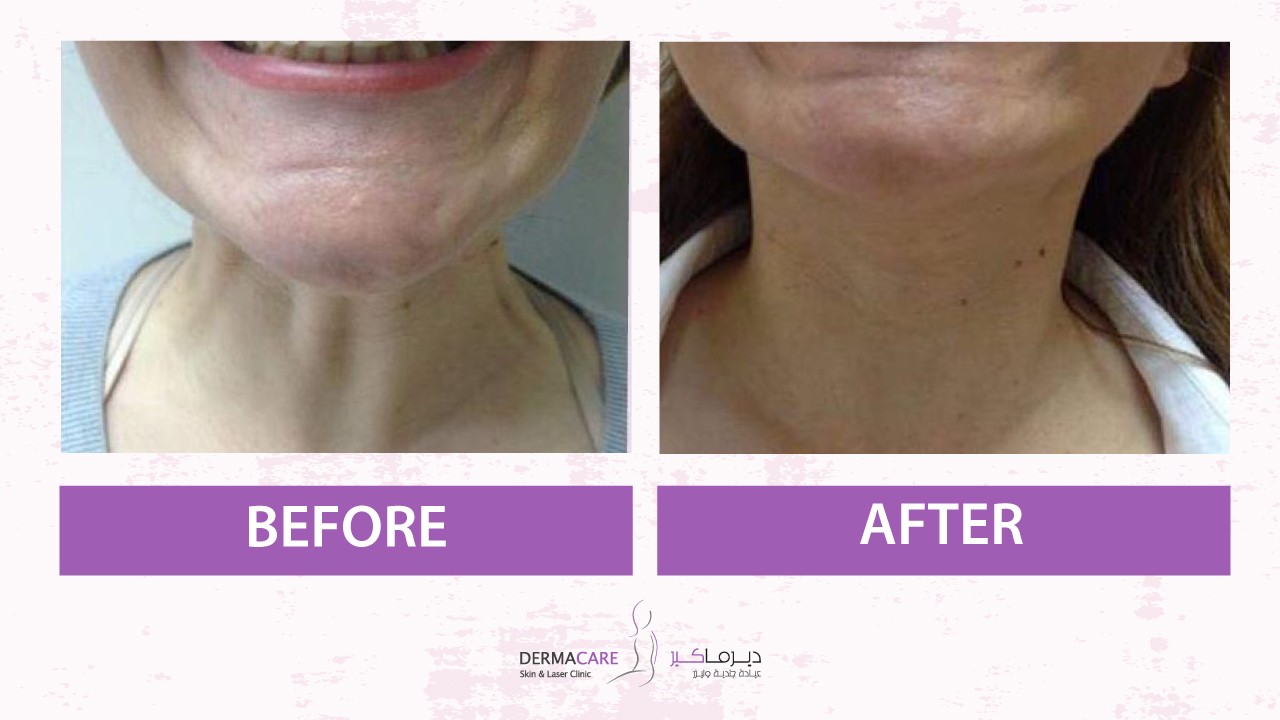 Double Chin and Neck