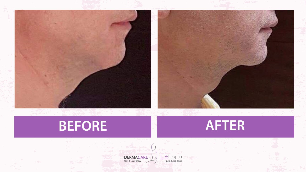 Non-surgical Face Lift