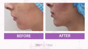 Non-surgical Face Lift