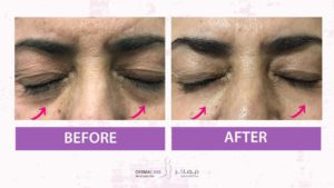 Non-surgical Face Lift