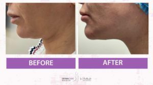 Double Chin and Neck