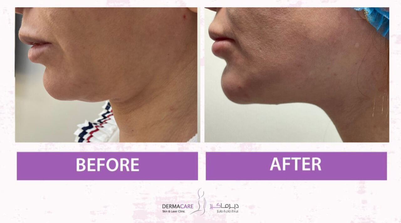 Double Chin and Neck