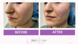 Non-surgical Face Lift