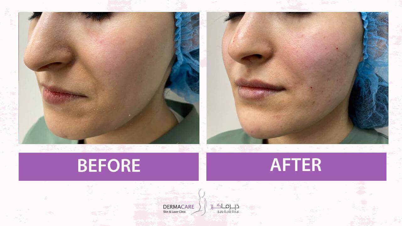 Non-surgical Face Lift