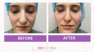 Non-surgical Face Lift