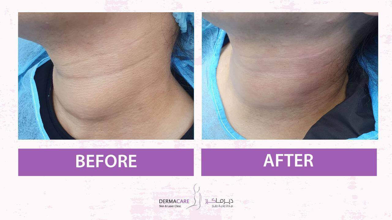 Double Chin and Neck